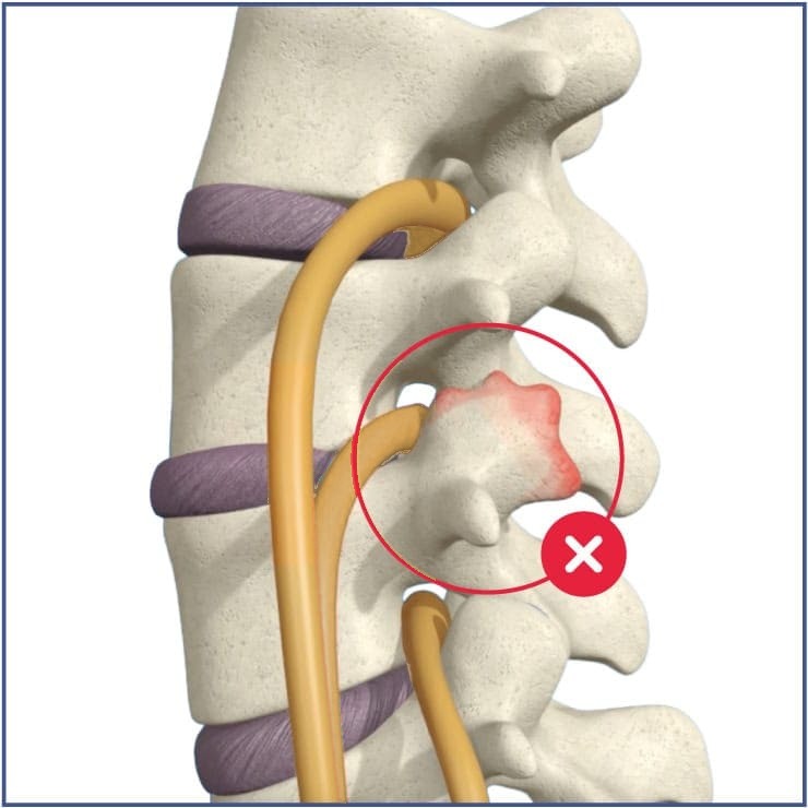 Degenerative facet joint with inflammation between two lumbar vertebrae