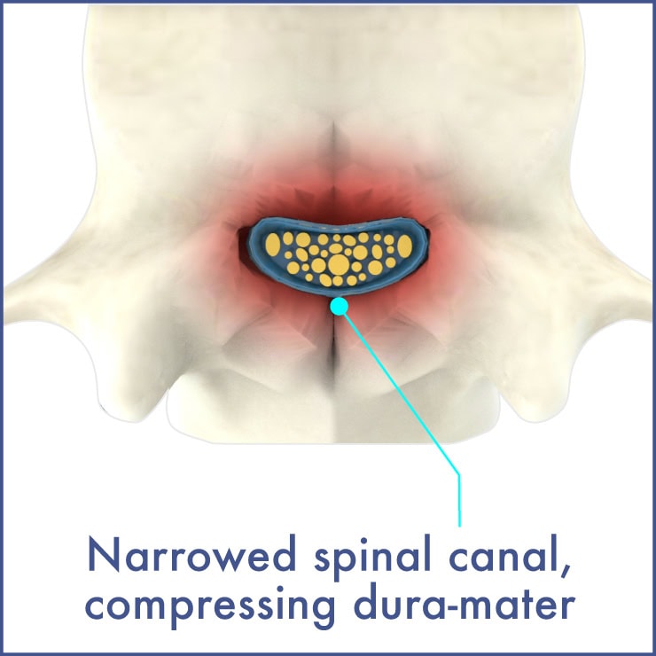 3-lumbar-spinal-stenosis-2