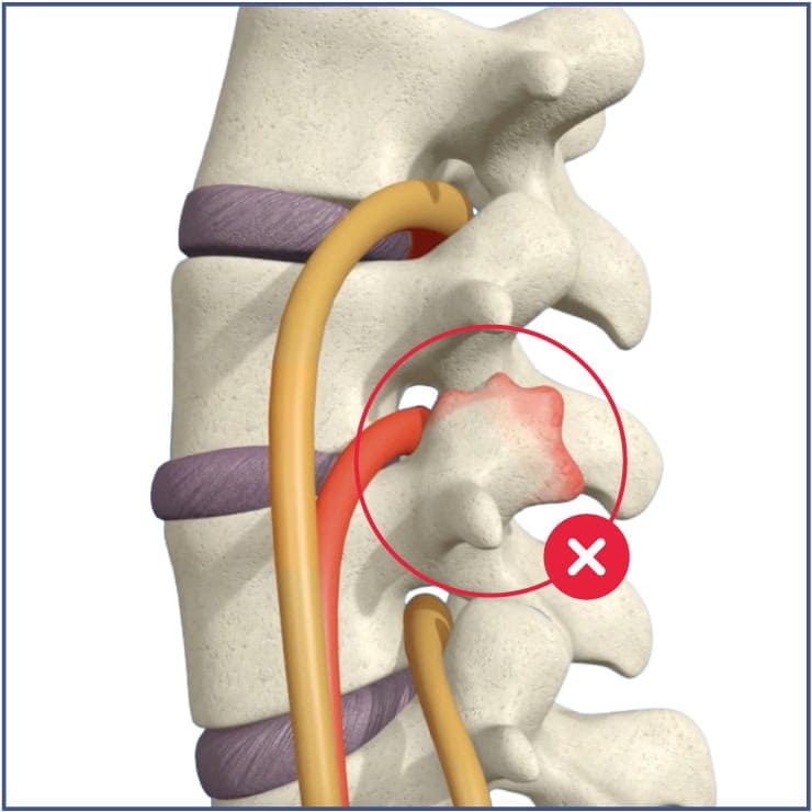 3-lumbar-spinal-stenosis