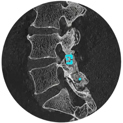 Sagittal CT scan of a lumbar facet arthrodesis with an FFX facet cage