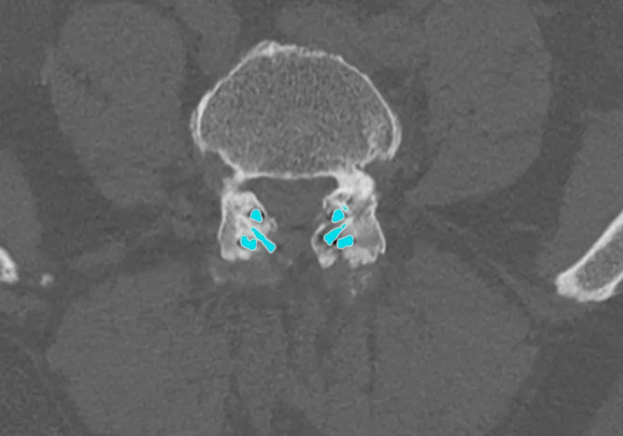 Axial CT scan 2 years after FFX surgery showing bony fusion of the facet joints