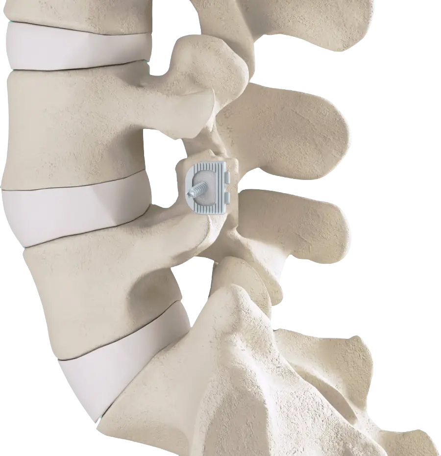 Lateral view of the lumbar spine with an FFX facet cage and FFX locking screw placed inside the facet joint