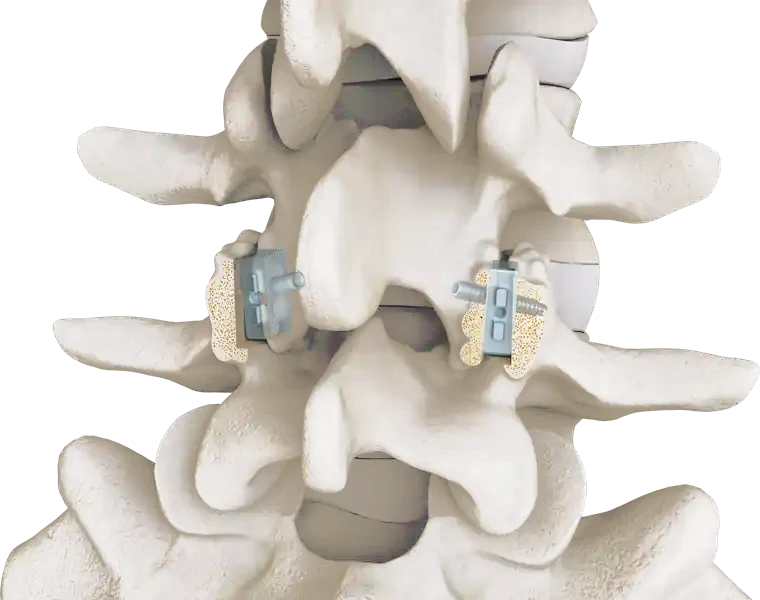 Posterior view of a lumbar segment with an FFX facet cage and FFX locking screw in each facet joint