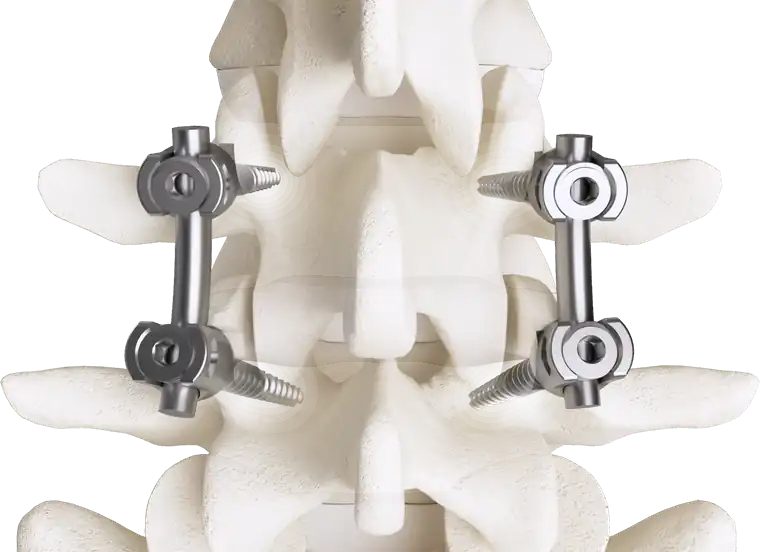 Posterior view of a single-level lumbar fusion with four Pedicle screws, their locking caps and two rods