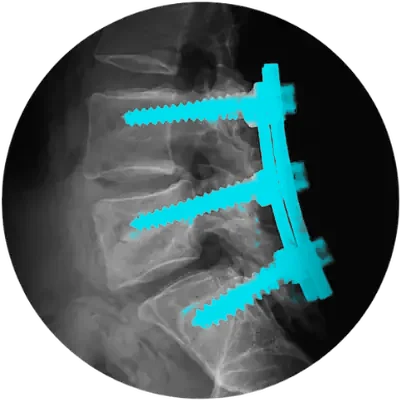 Lateral X-ray of a lumbar fusion with Pedicle screws and rods