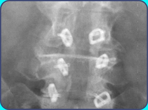 X-ray of a lumbar spine treated with FFX facet cages